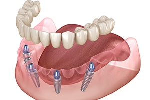 Illustration of denture being attached to All-on-4 implants in Springfield, IL