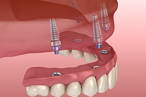 Illustration of dentures being placed on dental implants in upper jaw