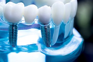 a model of a dental implant