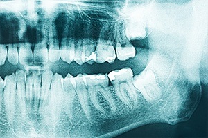 X-rays of smile